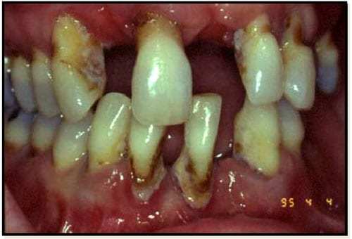 Periodontitis.jpg