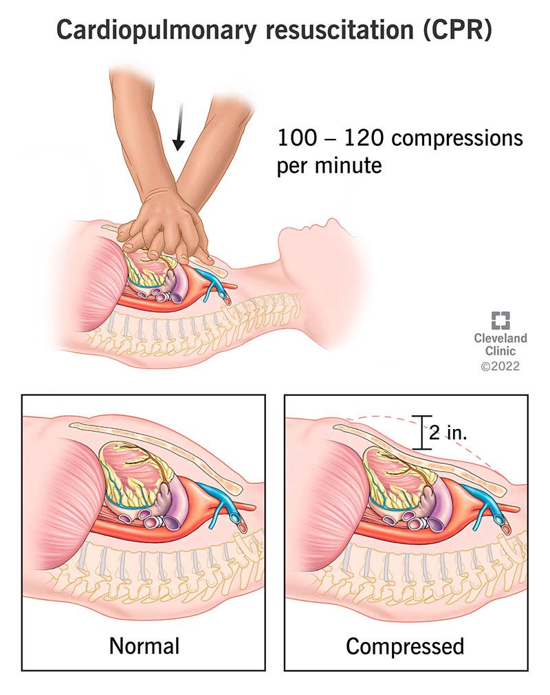 17680-cpr-instructions