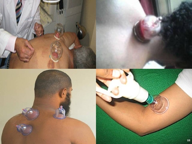 hijama.jpg